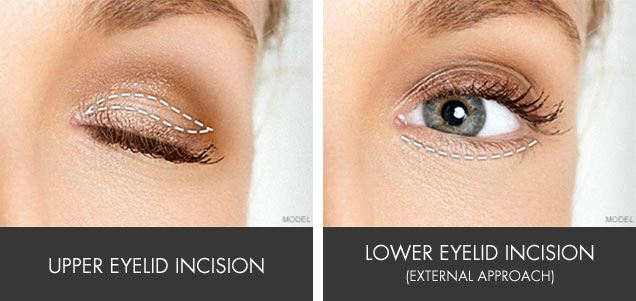 eyelid surgery recover does take upper incision eye line blepharoplasty lower along left sacramento open lines