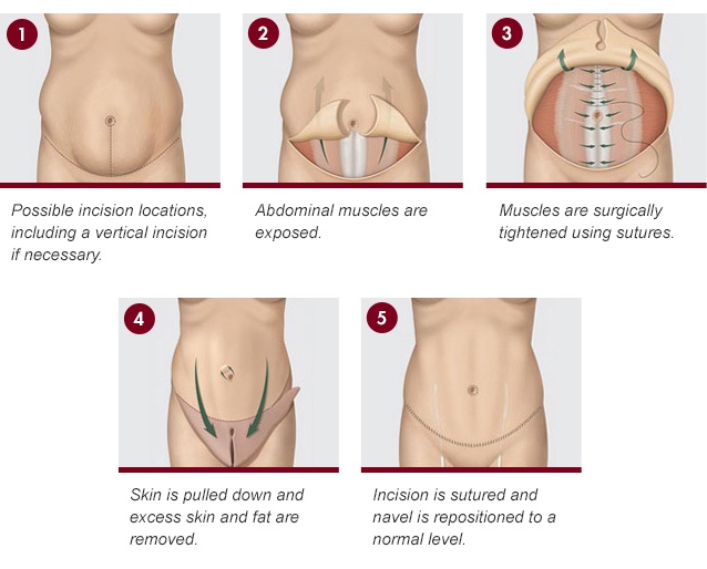 What To Expect With Tummy Tuck Recovery